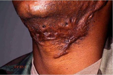 Keloid
